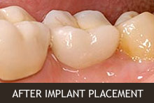 After Implant Placement