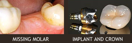 Missing Molar