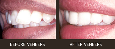 Porcelain Veneers